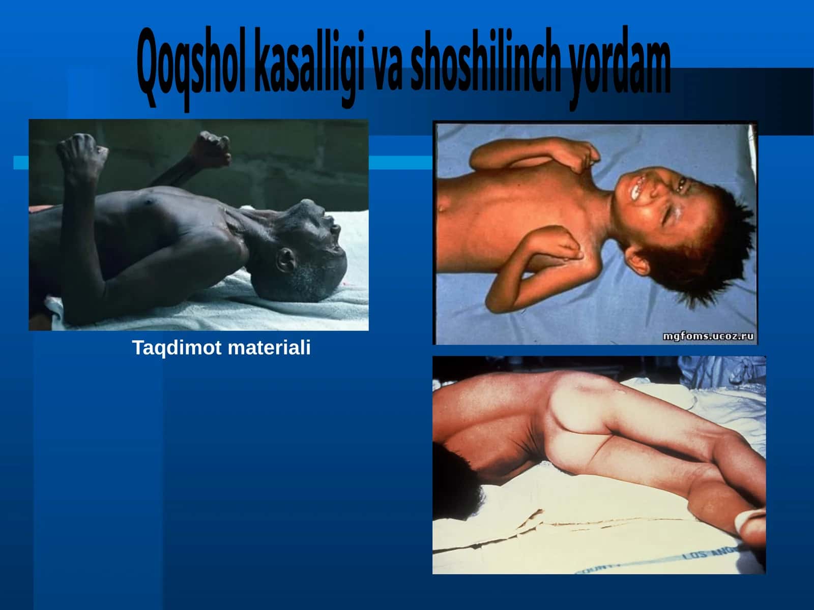 Qoqshol kasalligi va shoshilinch yordam 1