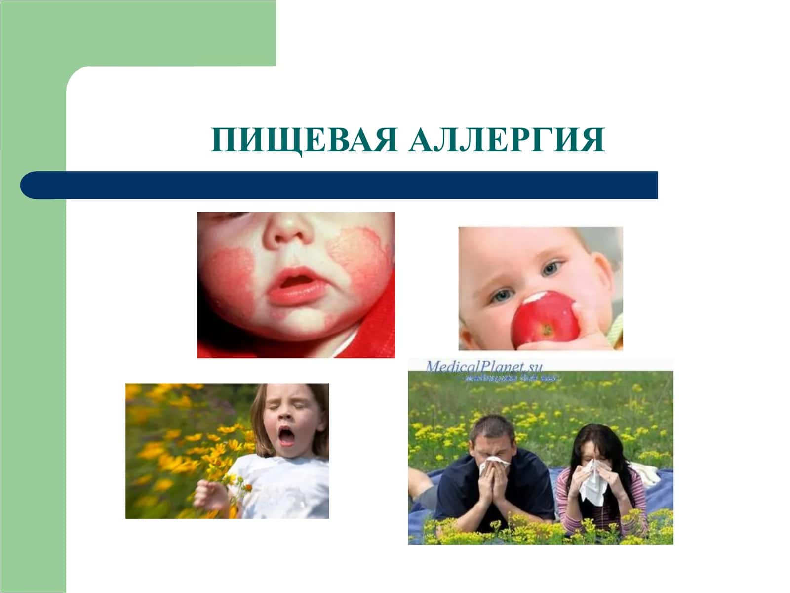 ПИЩЕВАЯ АЛЛЕРГИЯ 1
