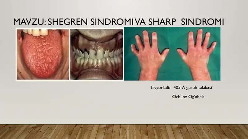 Shegren sindromi va Sharp sindromi 1