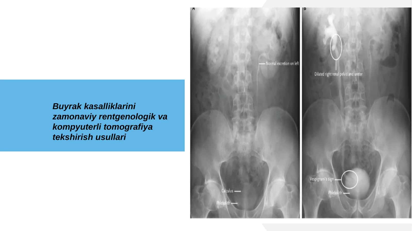 Buyrak kasalliklarini zamonaviy rentgenologik va kompyuterli tomografiya tekshirish usullari 1