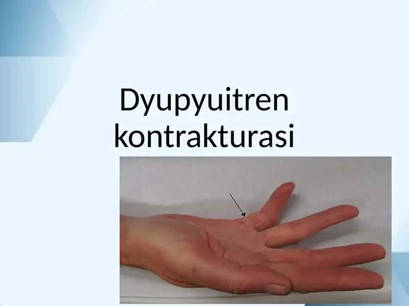 Dyupyuitren kontrakturasi 1