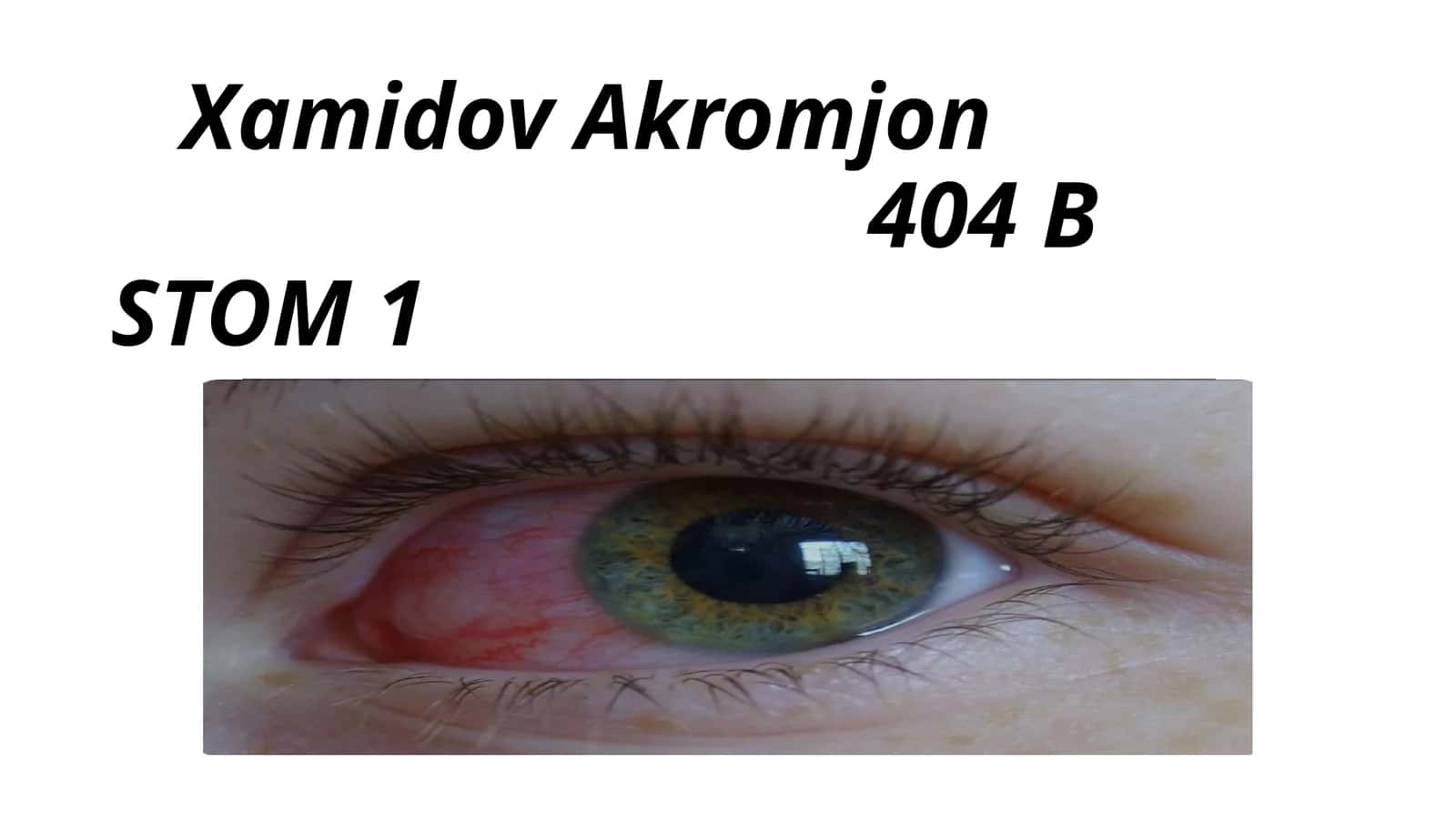 Virusli konyuktivit 1