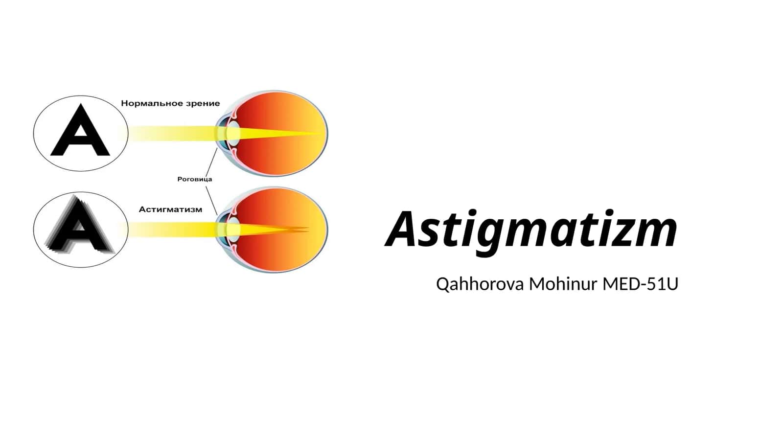 Astigmatizm 1