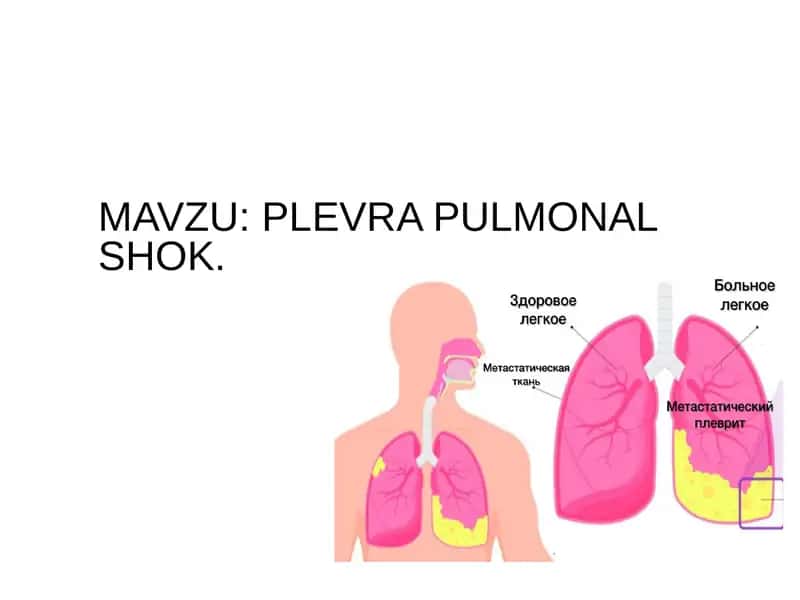 Plevra  pulmonal shok 1