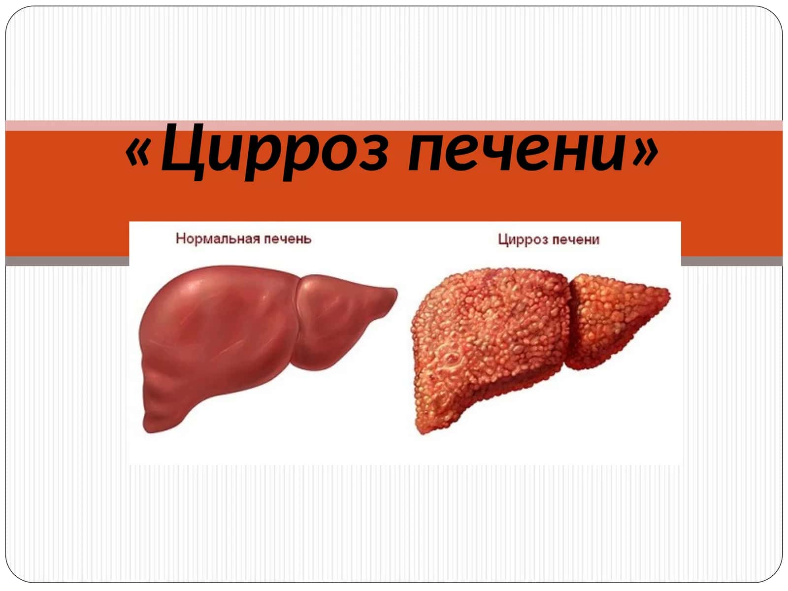 Цирроз печени 1