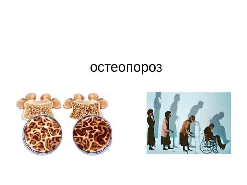 Остеопороз 1