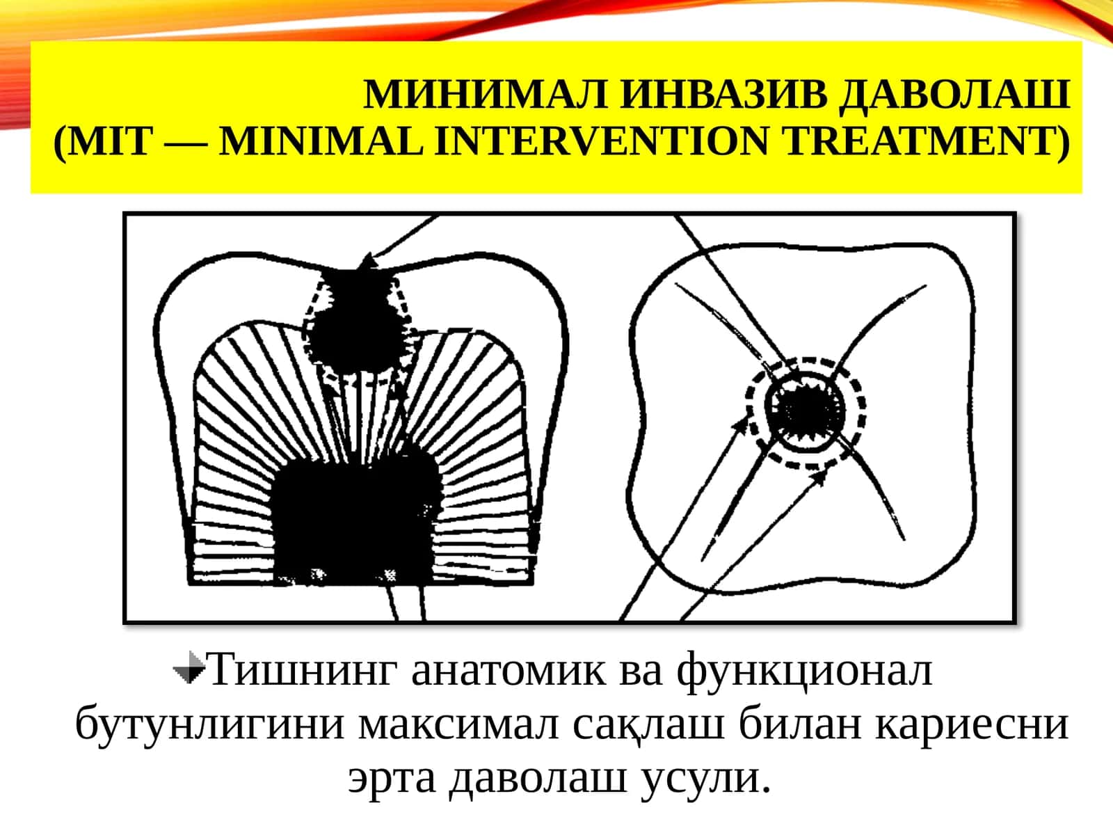 МИНИМАЛ ИНВАЗИВ ДАВОЛАШ(MIT—minimalinterventiontreatment) 1
