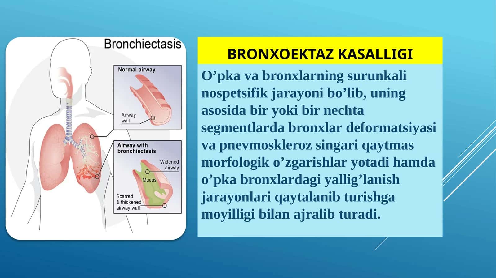 Bronxoektaz kasalligi 1