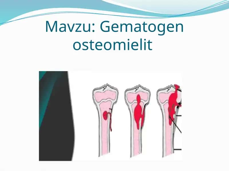 Gematogen osteomielit 1