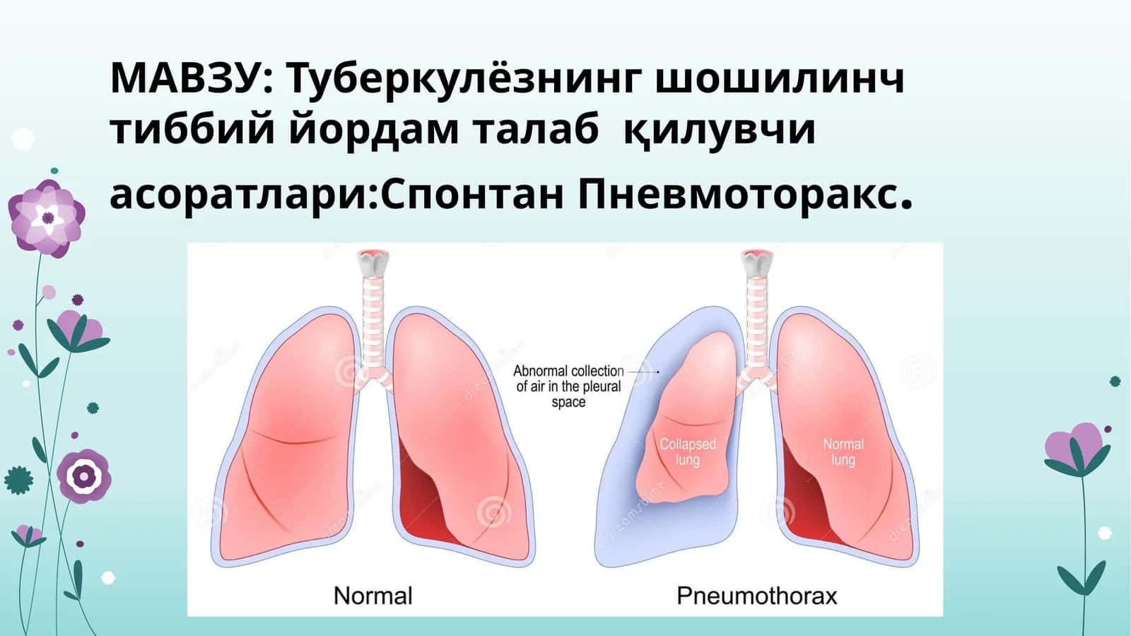 Tuberkulyozning shoshilinch tibbiy yordam talabqiluvchi asoratlari:Spontan Pnevmotoraks 1