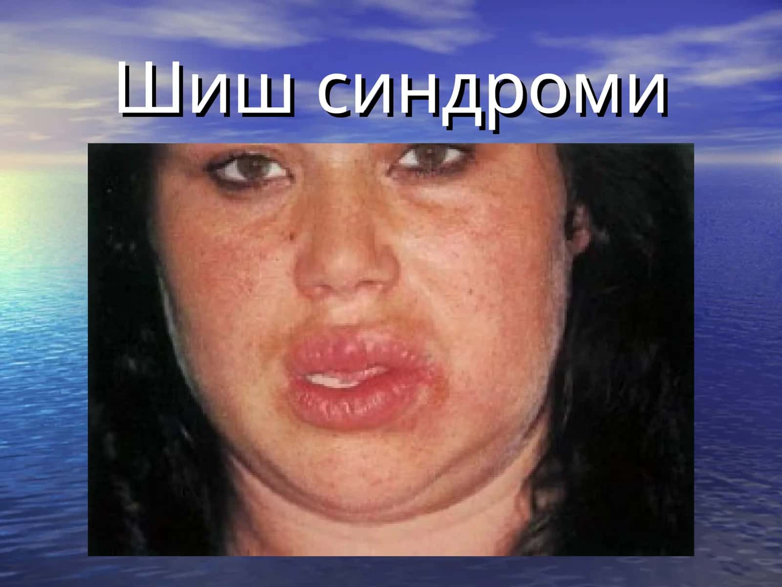 Шиш синдроми 1