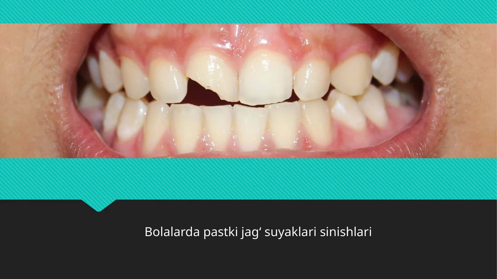 Bolalarda pastki jag‘suyaklari sinishlari 1