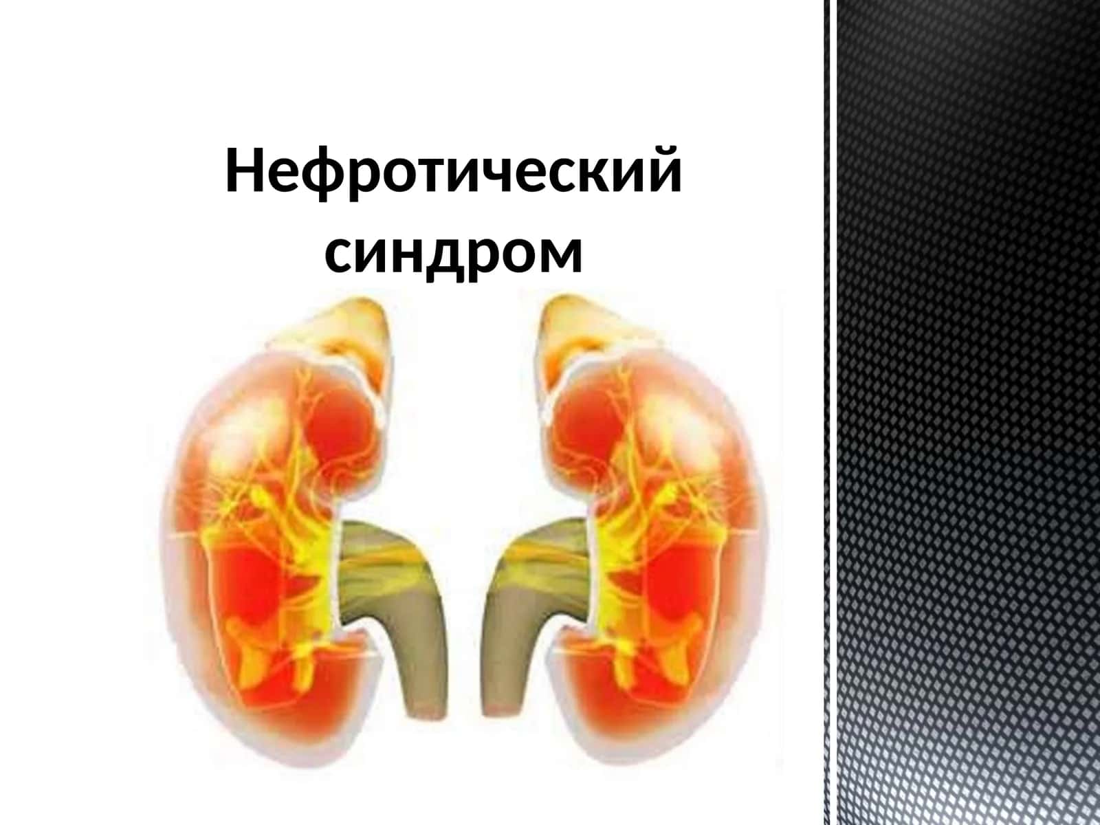 Нефротический синдром 1