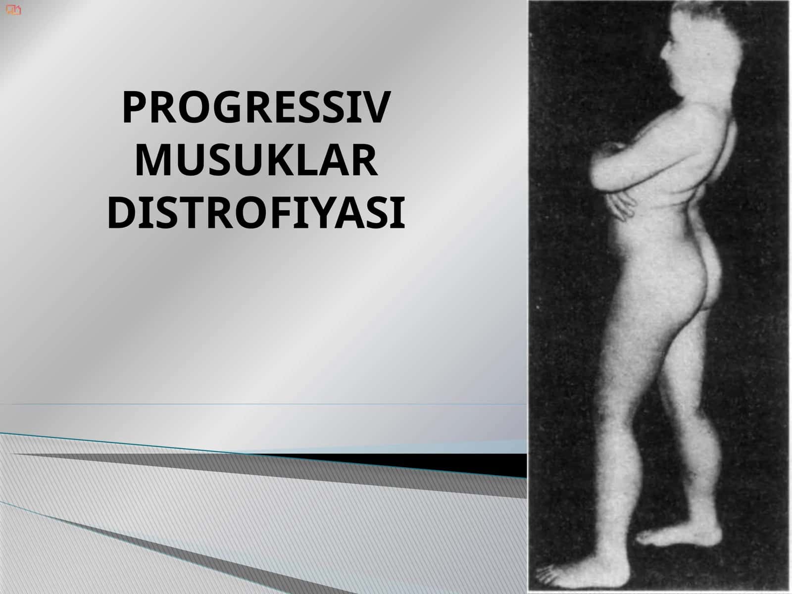 Progressiv Mushaklar Distrofiyasi 1