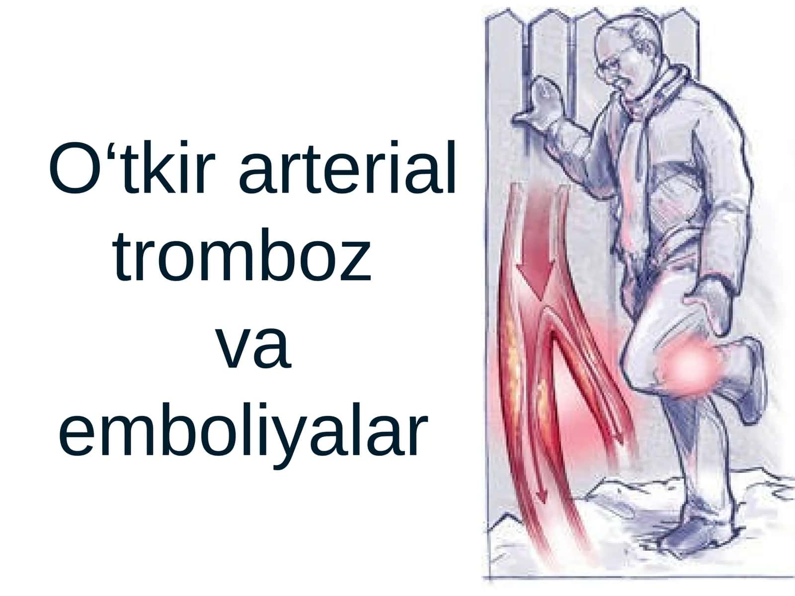 O‘tkir arterial tromboz va emboliyalar 1