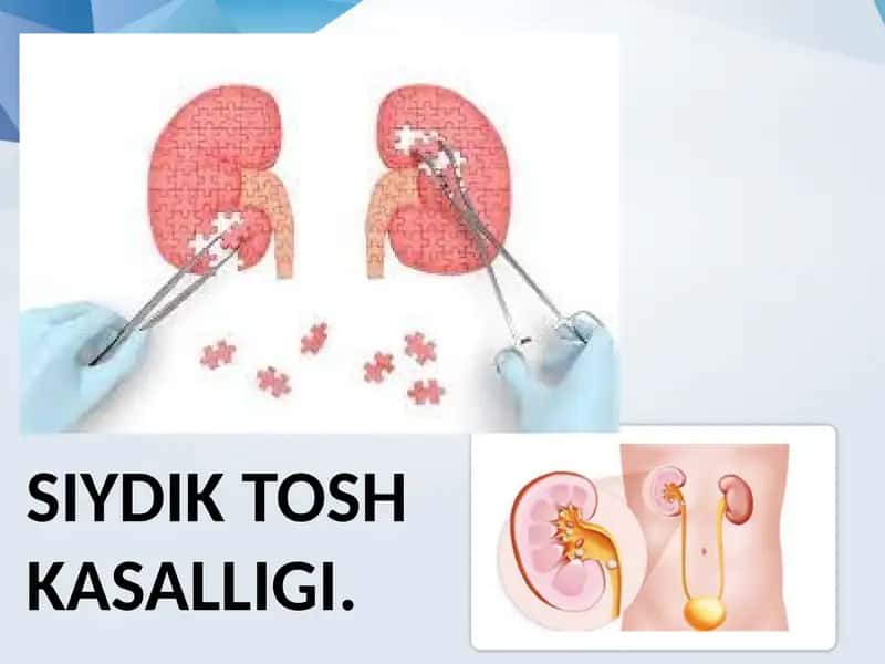 Siydik tosh kasalligi. 1