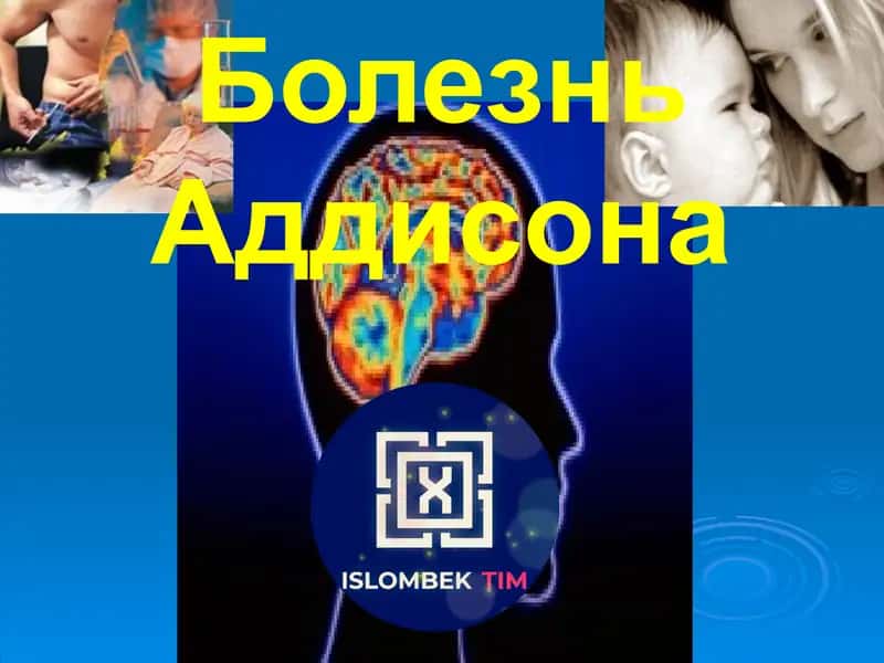 Болезнь Аддисона 1