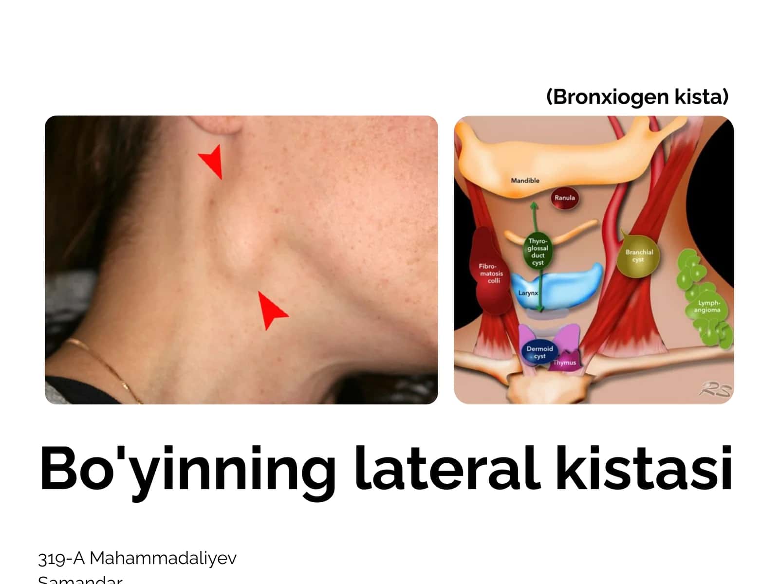 Bo'yinning lateral kistasi 1