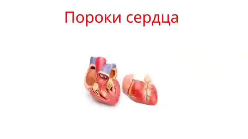пороки сердца 1