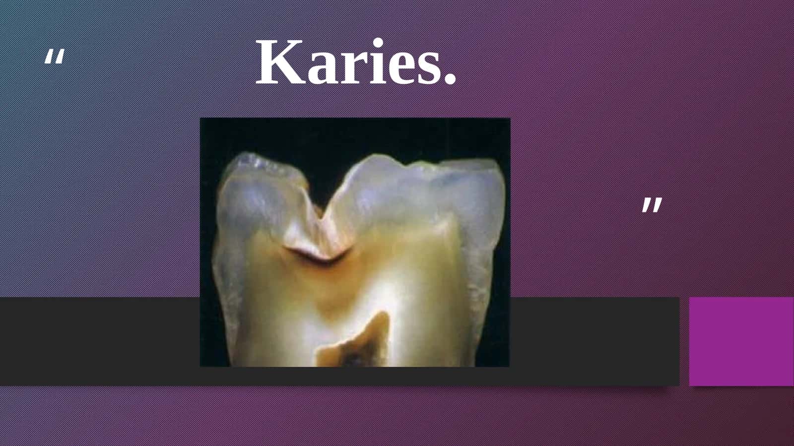 Karies haqida pirizintatsiya 1