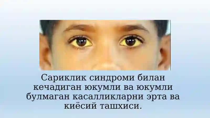 Сариклик синдроми