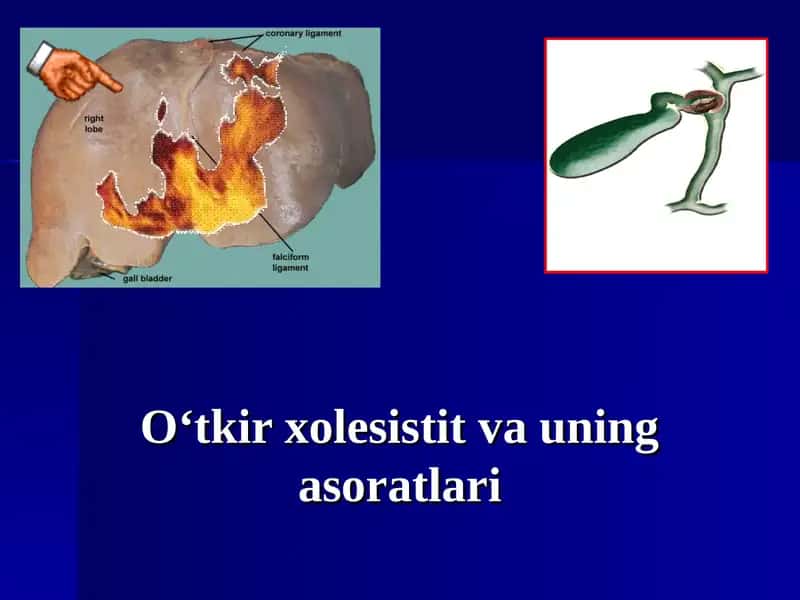 O‘tkir xolesistit va uning asoratlari 1