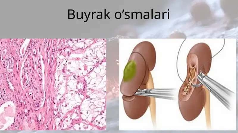 Buyrak o’smalari 1