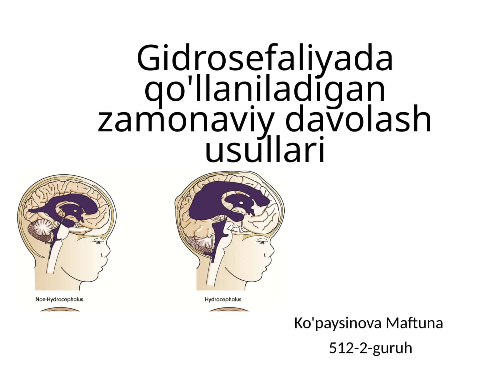 Gidrosefaliyada qo'llaniladigan zamonaviy davolash usullari 1