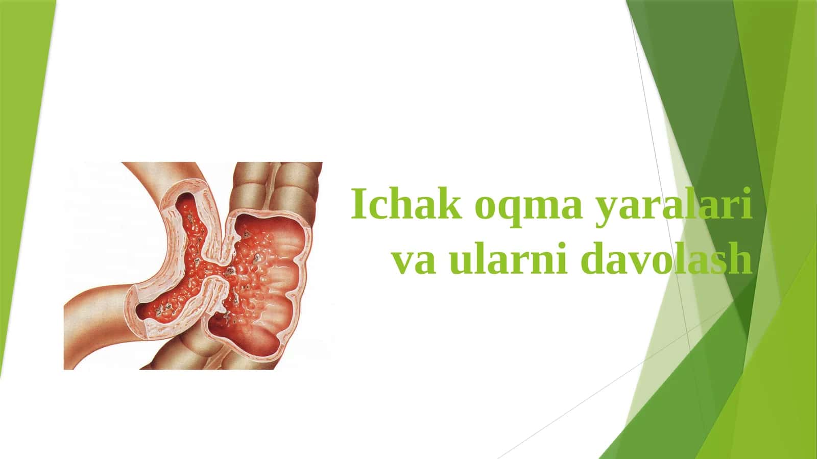 Ichakoqmayaralar va ularni davolash 1