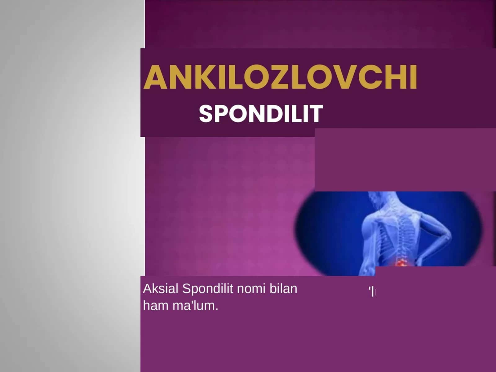Ankilozlovchi Spondilit 1