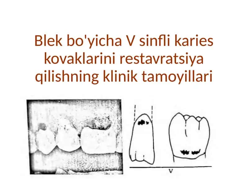 Blek 5-sinf. Karies kovaklarini restavratsiya qilishning klinik tamoyillari 1