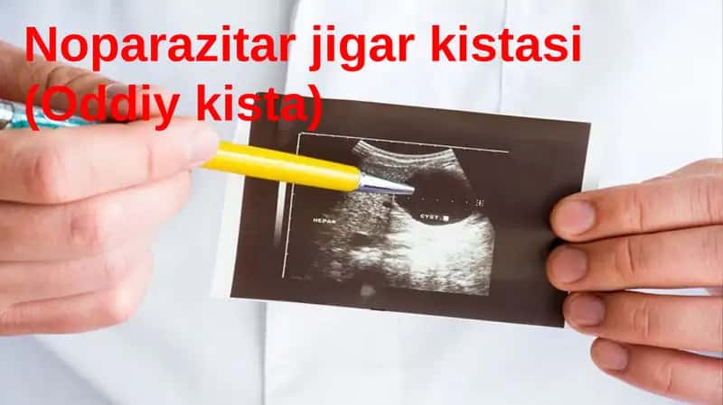 Noparazitar jigar kistasi 1