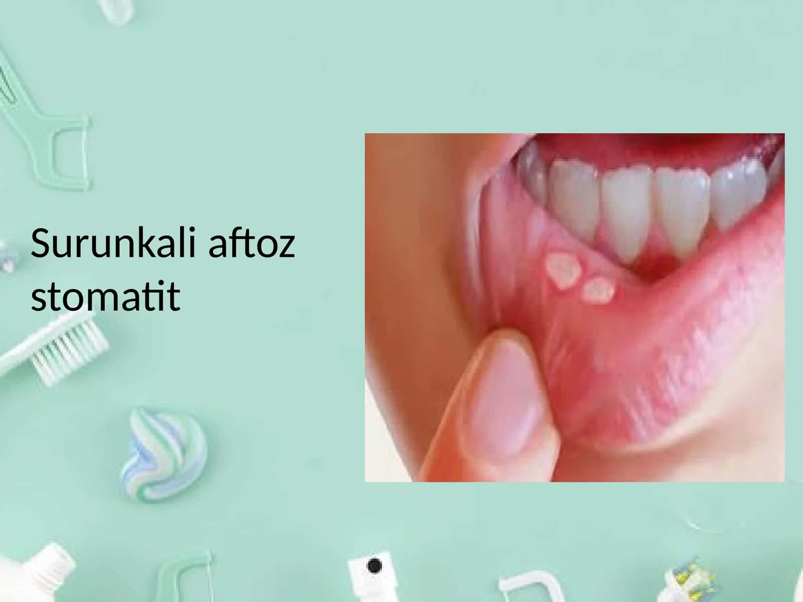 Surunkali aftoz stomatit 1