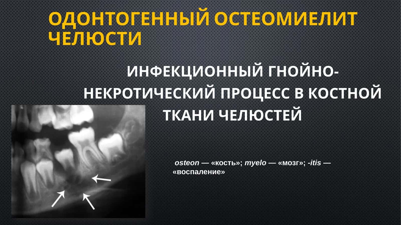 Одонтогенныйостеомиелитчелюсти 1