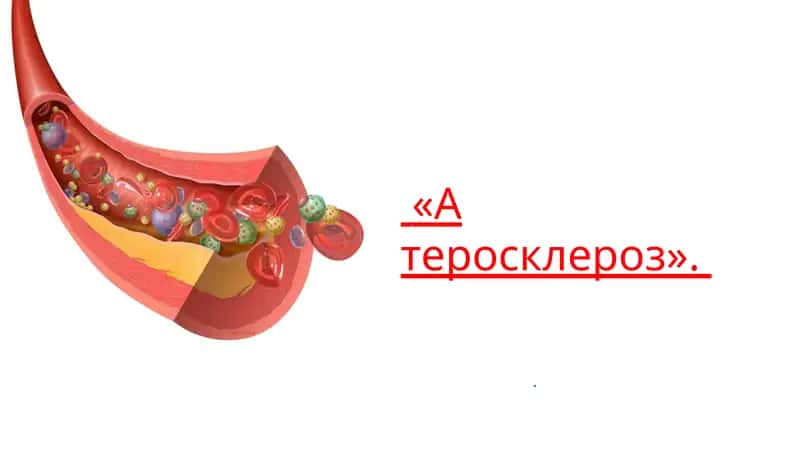 Атеросклероз 1