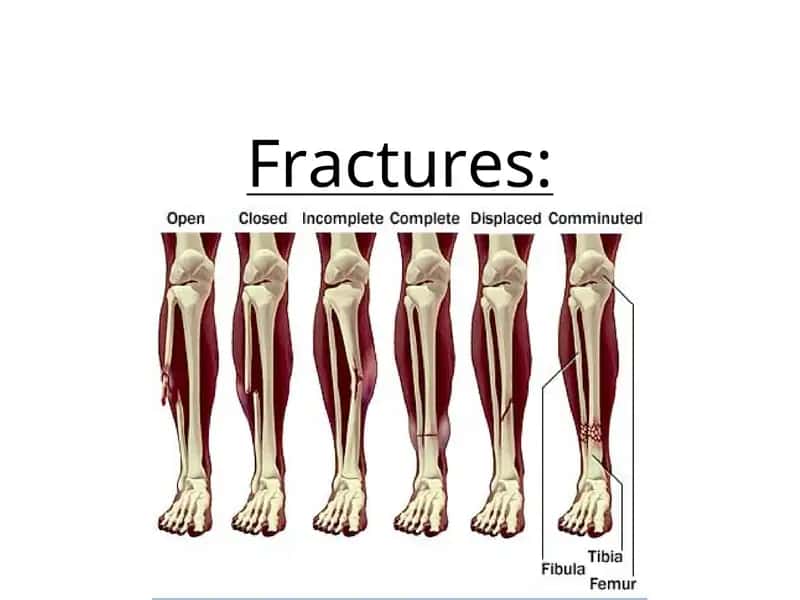 Fractures 1
