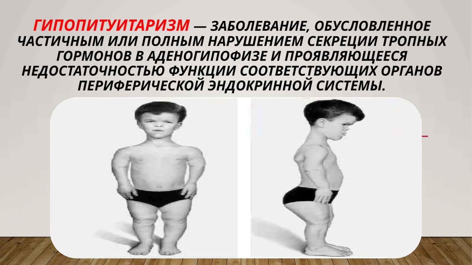 Гипопитуитаризм 1