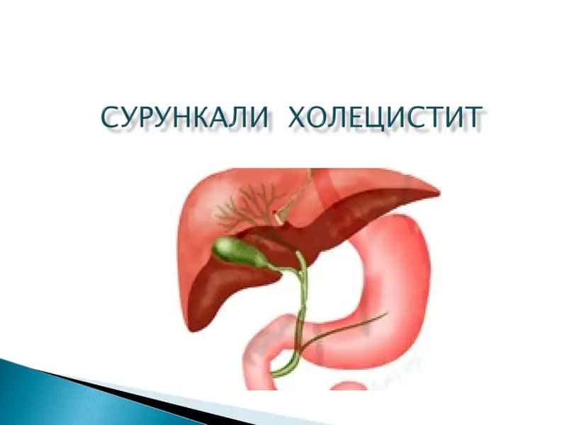 Холецистит 1