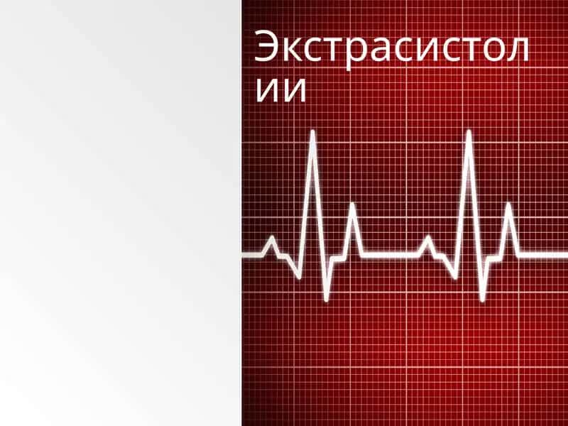 Экстрасистолии 1