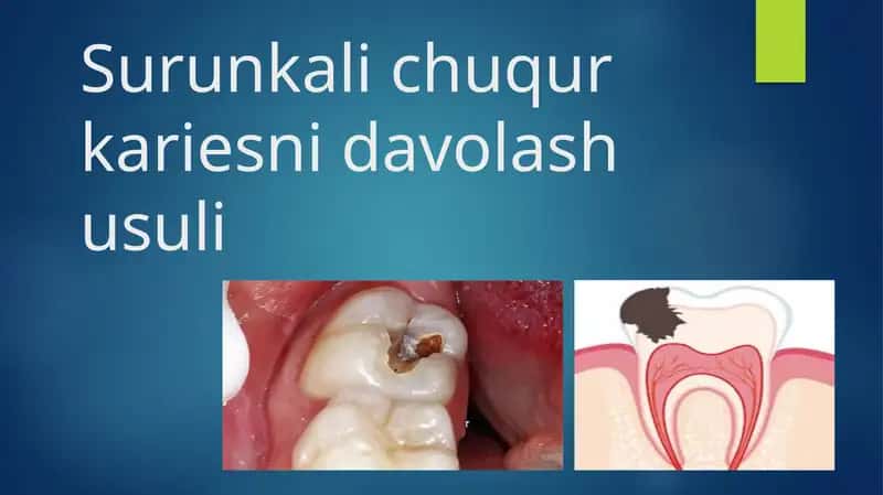 Surunkali chuqur kariesni davolash usuli 1
