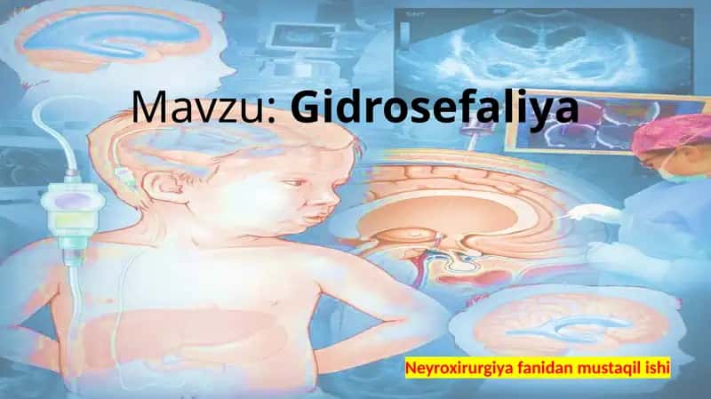 Gidrosefaliya 1