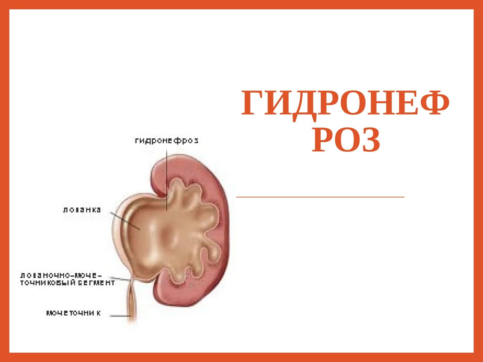 Гидронефроз 1