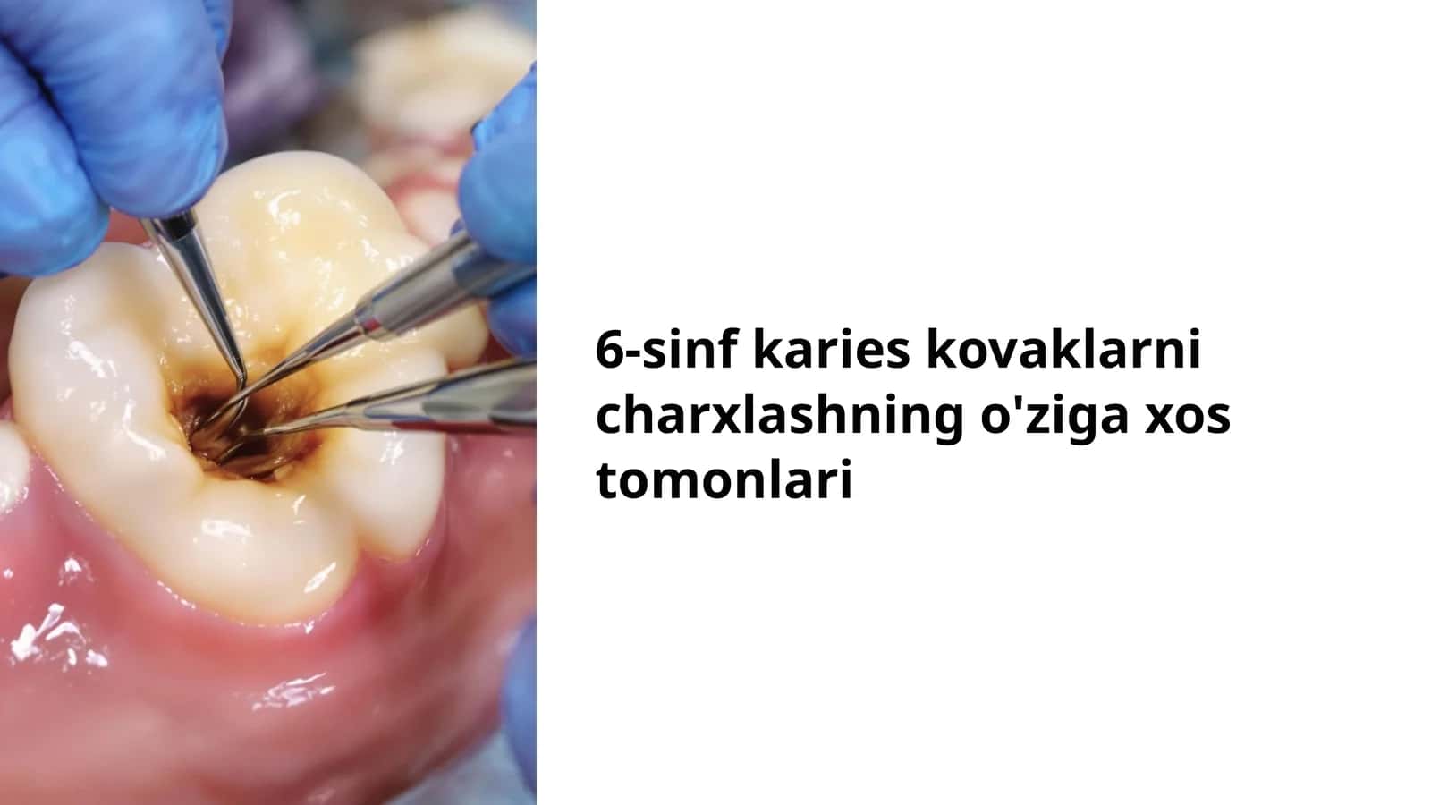 6-sinf karies kovaklarni charxlashning o'ziga xos tomonlari 1