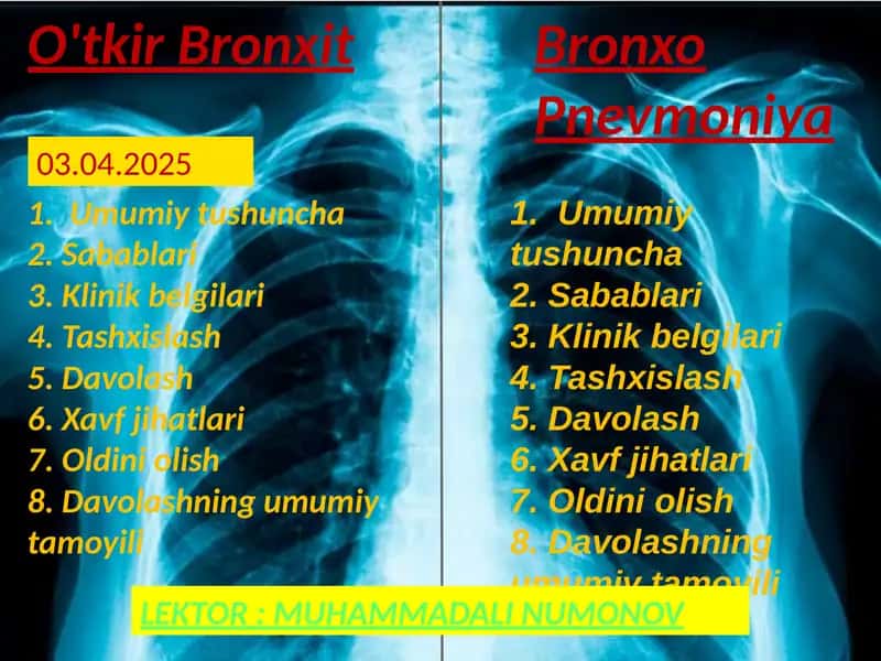 O'tkirBronxit 1