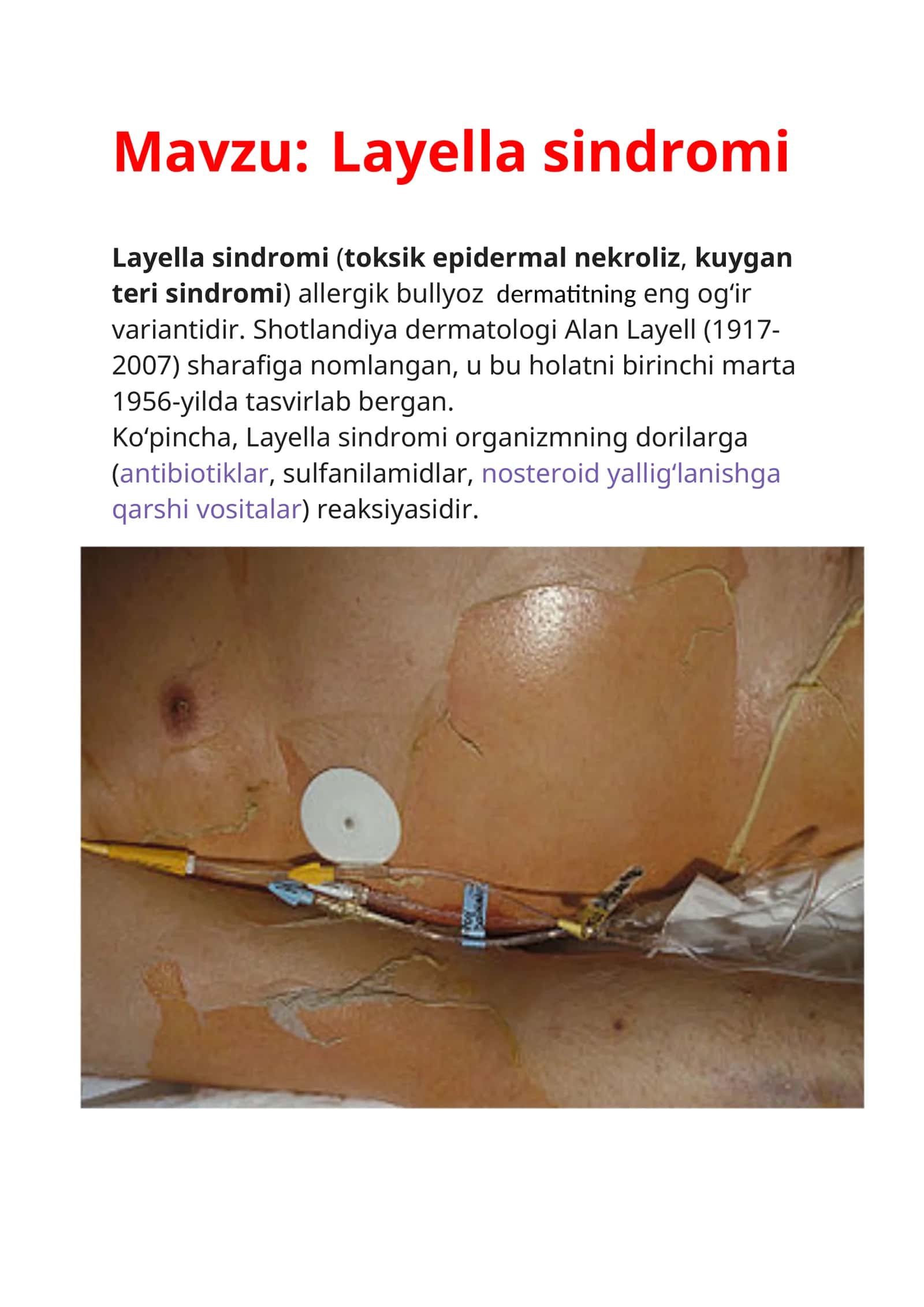 Layella sindromi 1