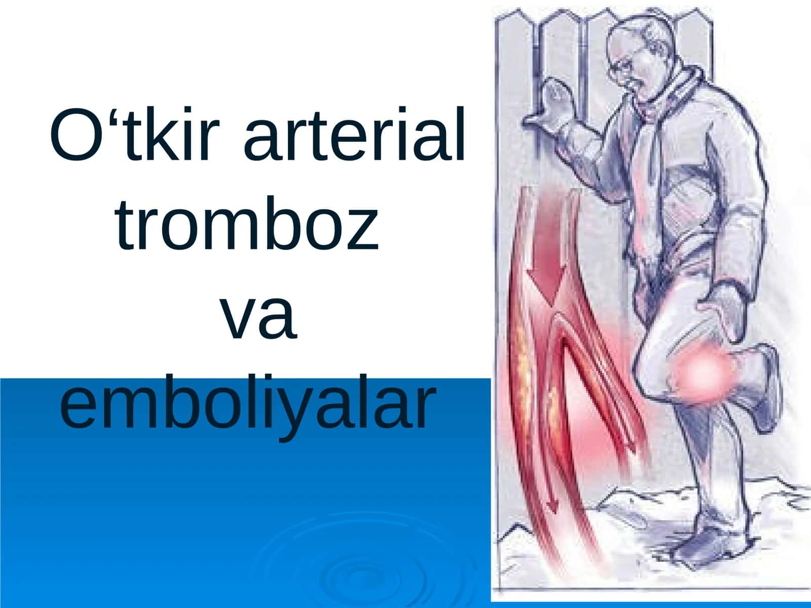 O‘tkir arterial trombozva emboliyalar 1