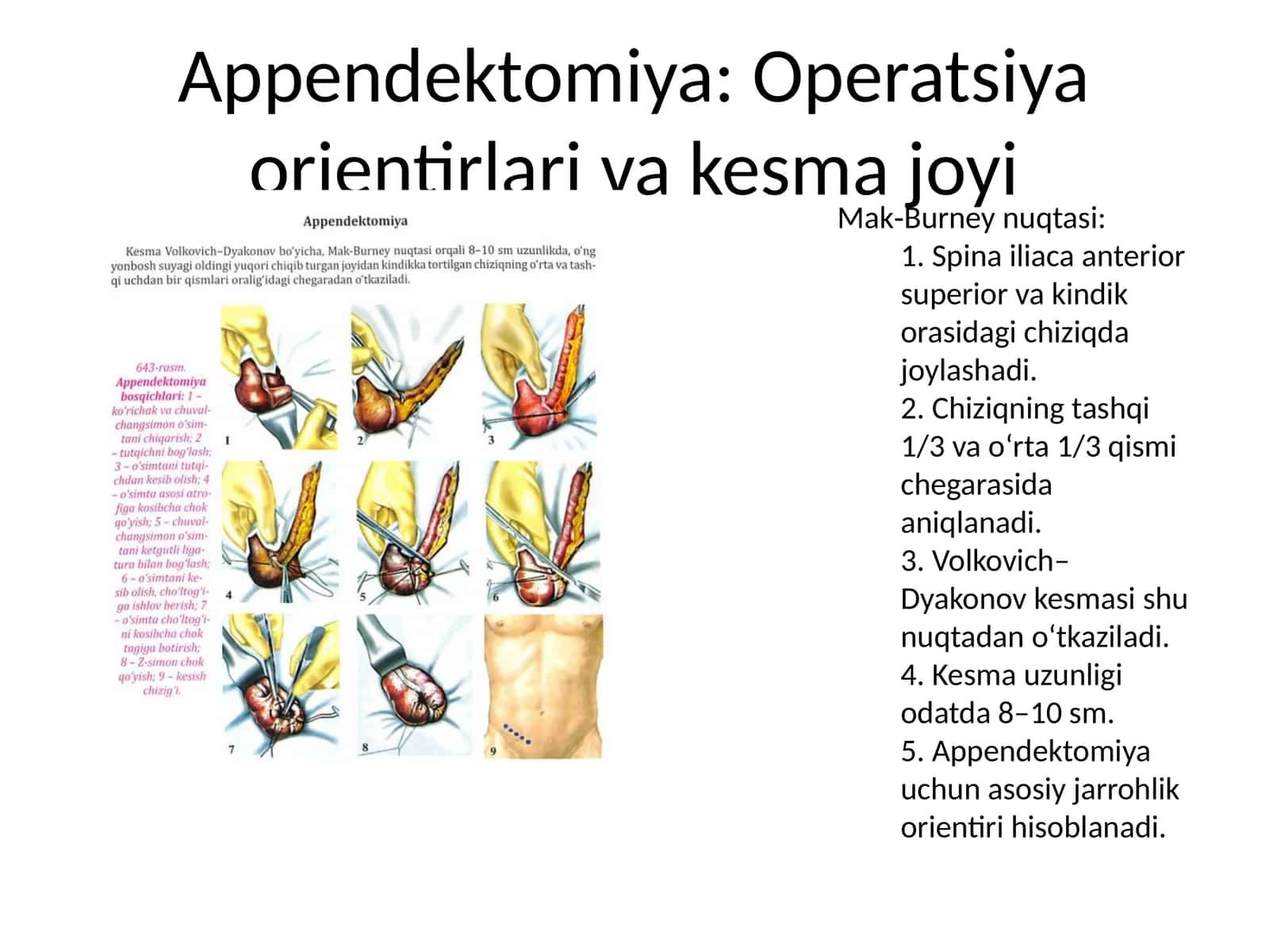 Appendektomiya: Operatsiya orientirlari va kesma joyi 1