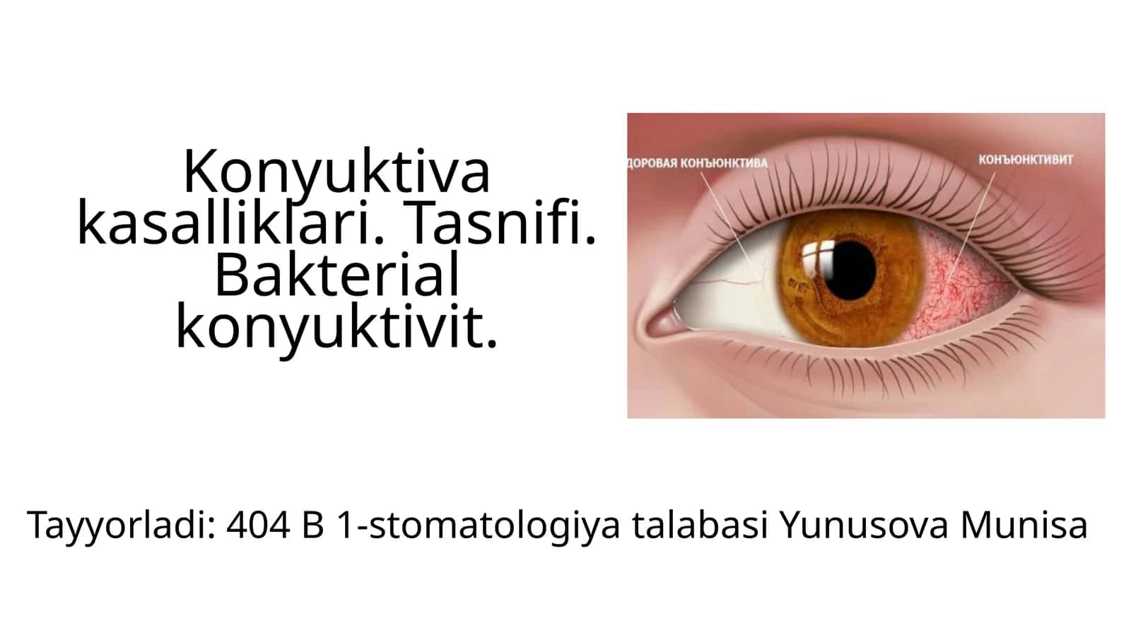 Konyuktivakasalliklari.Tasnifi.Bakterialkonyuktivit 1