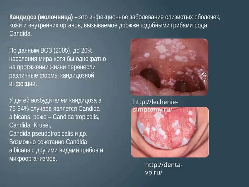 Кандидоз(молочница) 1