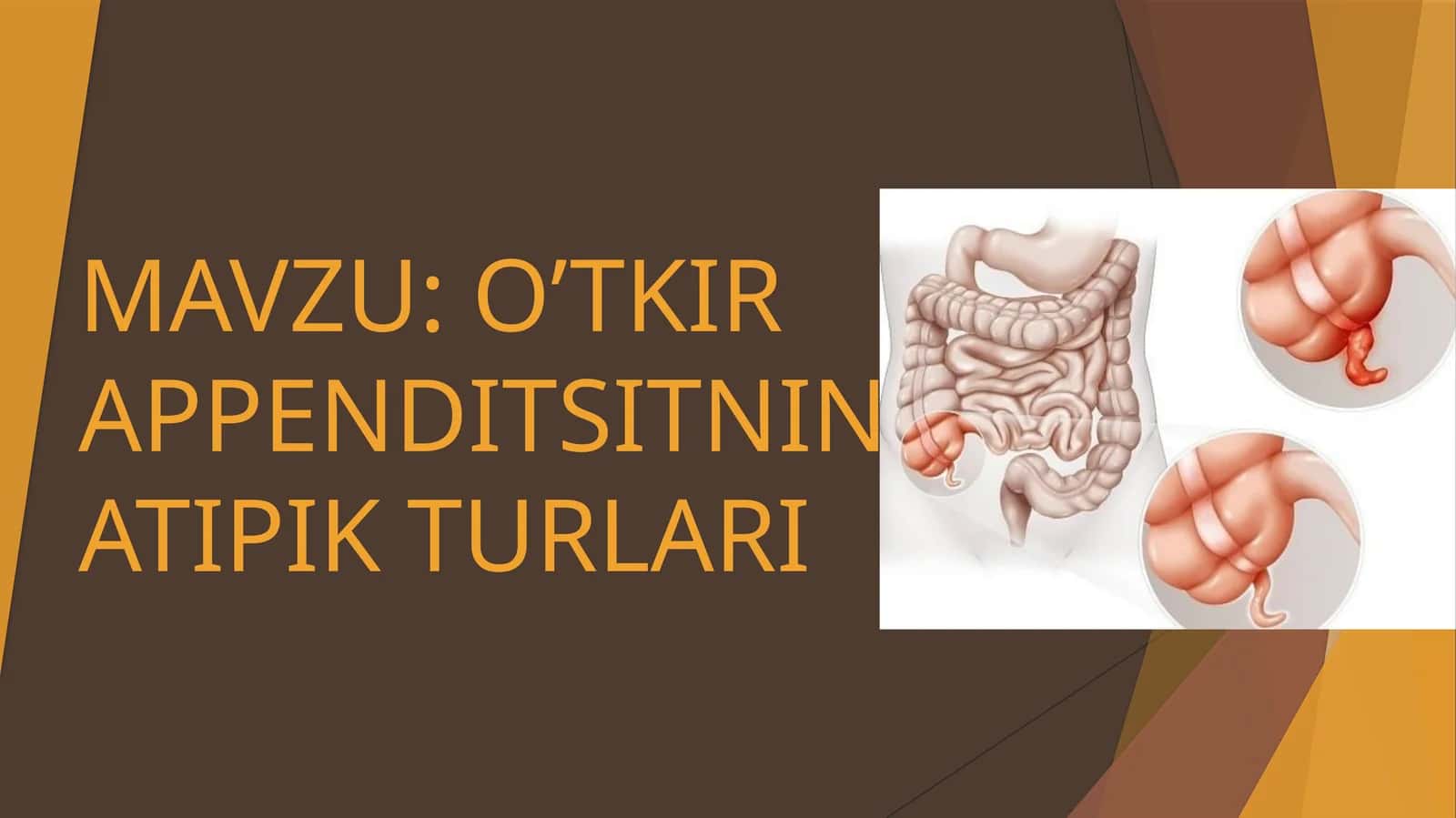 O’TKIR APPENDITSITNING ATIPIK TURLARI 1